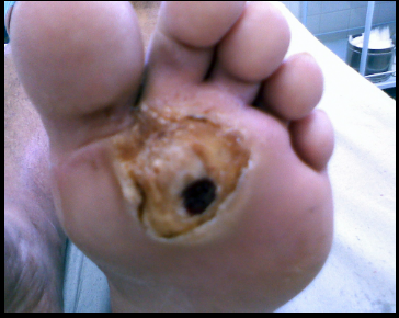 Mal perfurante plantar