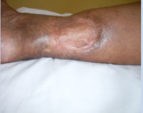 Tratamento de feridas